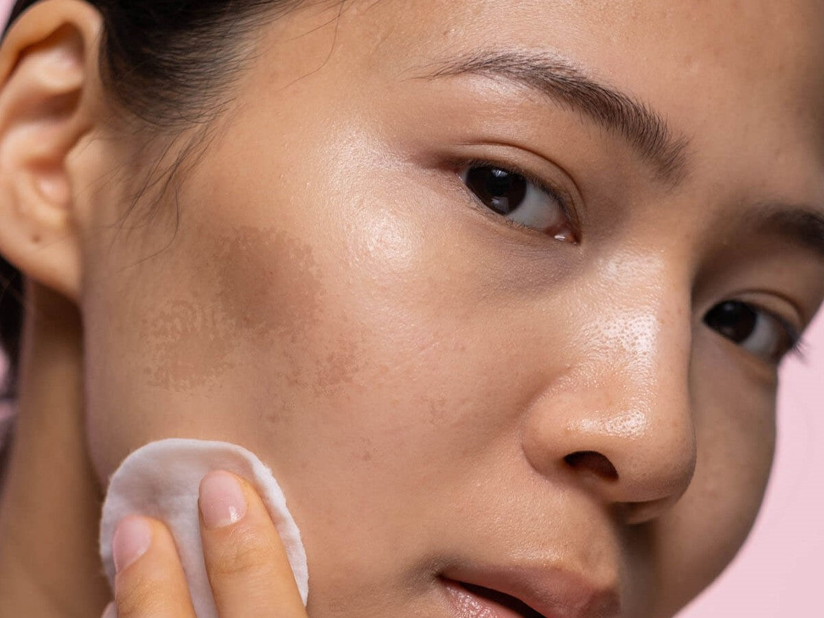 What is hyperpigmentation and how do you best treat this skin condition?